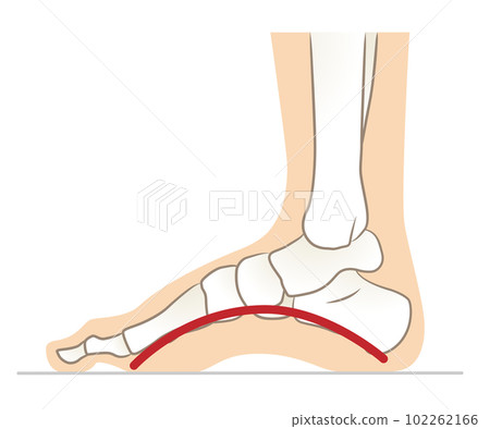 Feet with too high arches, feet with high arches 102262166