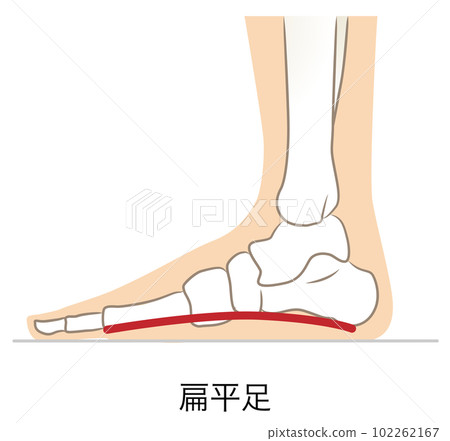 Feet without arches, feet with flat feet 102262167