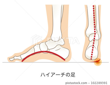 Side and back of high arch foot Side and back of high arch foot 102289391