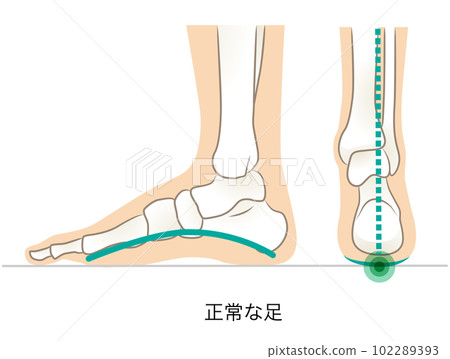 正常足弓足的外側和後部 102289393
