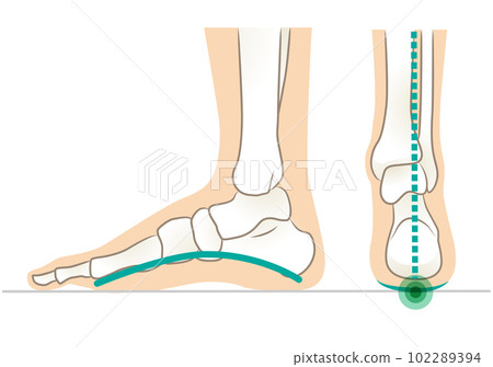 Lateral and posterior aspect of foot with normal arch Lateral and posterior aspect of foot with normal arch 102289394