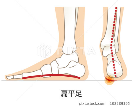 Lateral and posterior aspects of flat feet Lateral and posterior aspects of flat feet 102289395