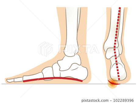 Lateral and posterior aspects of flat feet 102289396