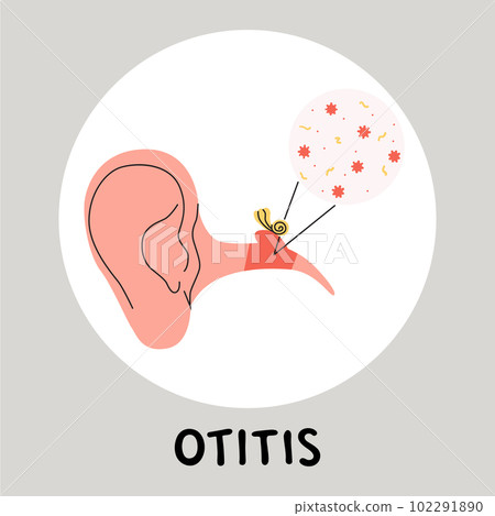 Otitis media flat vector medically illustration. Earache becouse of infection in the middle ear. Inflammatory diseases Otitis media flat vector medically illustration. Earache becouse of infection in the middle ear. Inflammatory diseases 102291890