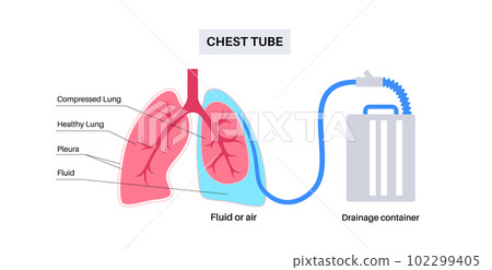 Chest tube catheter 102299405
