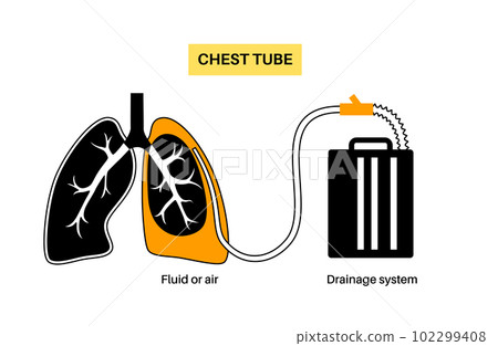 Chest tube catheter 102299408