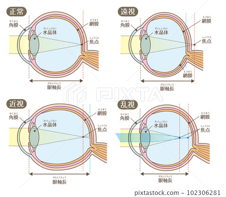 Eye structure_Visual acuity (myopia, hyperopia, astigmatism) 102306281