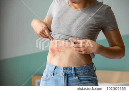 Painful shingles in woman 102309663