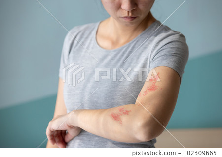 Painful shingles in woman 102309665