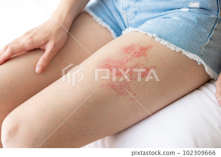 Painful shingles in woman 102309666