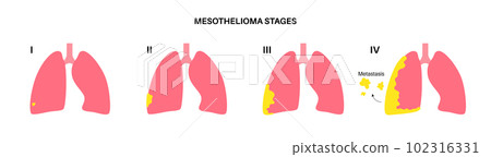 Mesothelioma cancer stages 102316331
