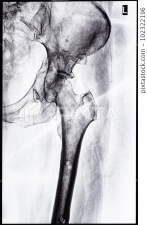 x-ray of junction of tibia and pelvis after healed 102322196