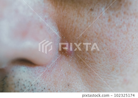 鼻子旁邊長痘痘 102325174