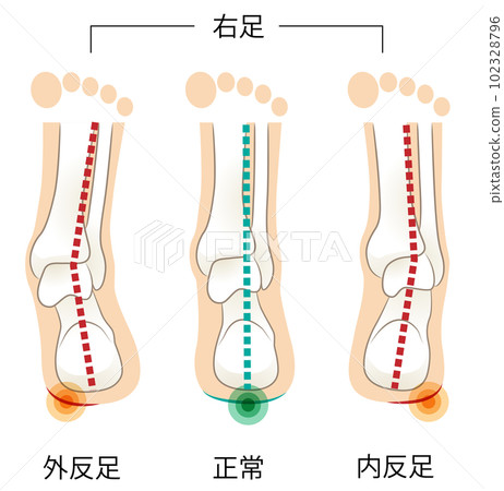 從後面看右腳跟骨和腳後跟的傾斜度 102328796