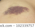 bruise on skin 102339757