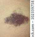 bruise on skin 102339758