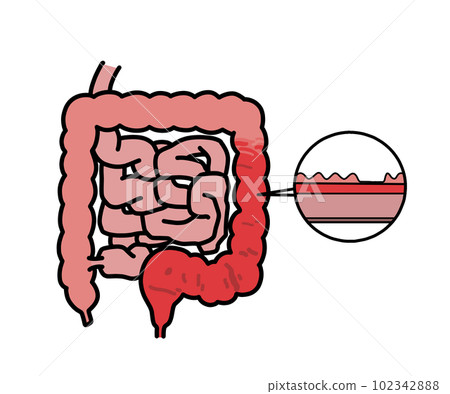 Ulcerative colitis (no letters) 102342888