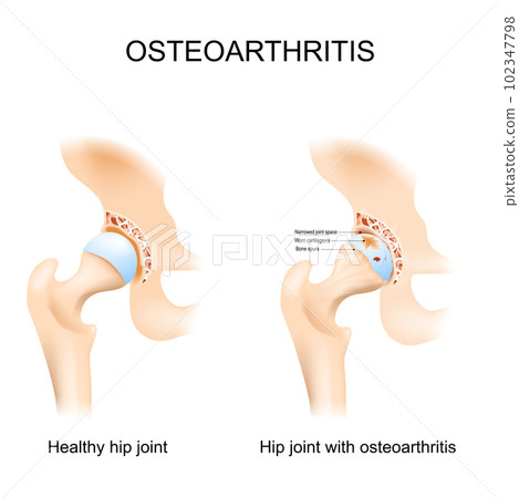 Hip joint with osteoarthritis 102347798