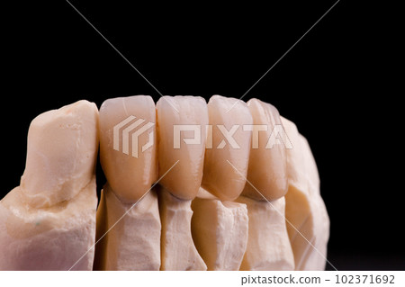 Dental Innovations: Crown Technology for a Brighter Smile 102371692