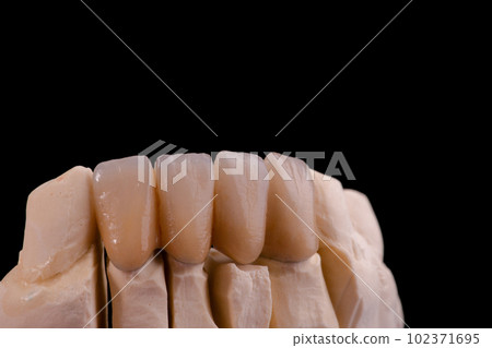 Crown Your Smile: The Ultimate Dental Transformation 102371695