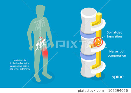 3D Isometric Flat Vector Conceptual Illustration of Sciatica Nerve Pain 102394056