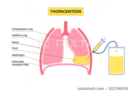 Thoracentesis medical procedure 102396056