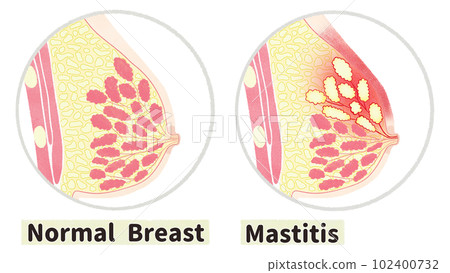 健康女性乳房與乳腺炎的比較英文插圖 健康女性乳房與乳腺炎的比較英文插圖 102400732