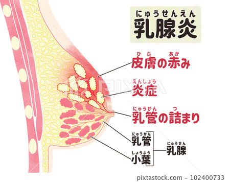Symptoms of mastitis Illustration in Japanese 102400733