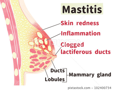 乳腺炎的症狀英文插圖 乳腺炎的症狀英文插圖 102400734