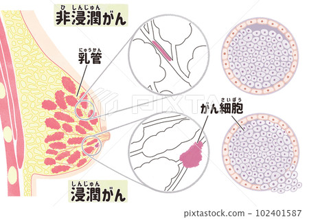Schematic illustration of ductal carcinoma in situ (DCIS) and invasive ductal carcinoma (IDC) 102401587