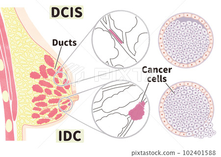 Schematic illustration of ductal carcinoma in situ (DCIS) and invasive ductal carcinoma (IDC) 102401588