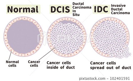 乳腺癌非侵入性癌症和侵入性癌症的插圖插圖 102401591