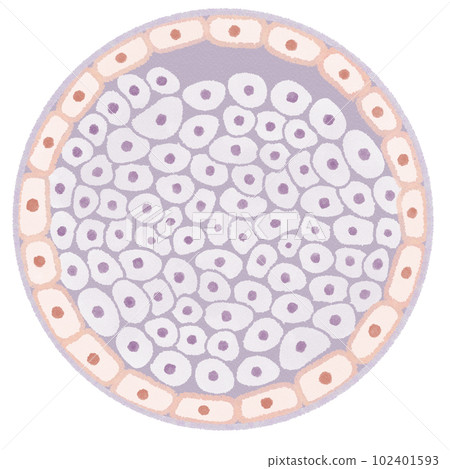 導管原位癌 (DCIS) 示意圖 102401593