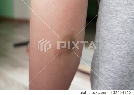 Closeup of hands applying balm to leg. Knee injury, skin hematoma, skin repair concept. slow motion 102404140