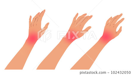Left hands with carpal tunnel syndrome 102432050