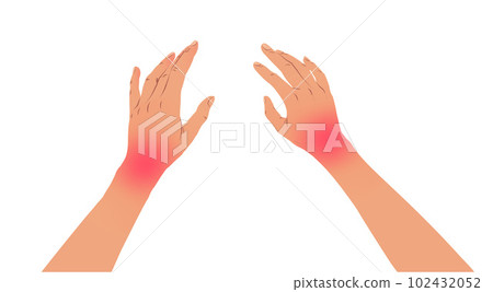 Hands with carpal tunnel syndrome 102432052