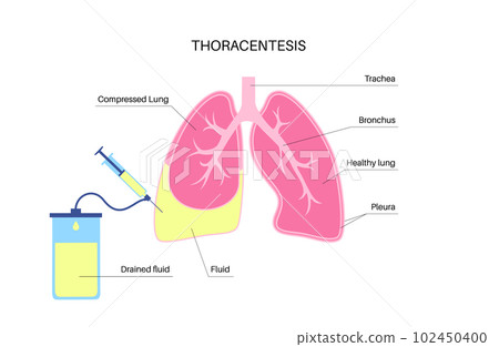 Thoracentesis medical procedure 102450400