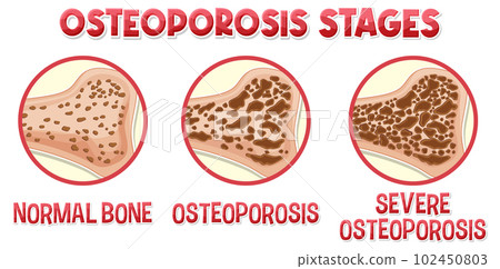 Informative poster of Osteoporosis human bone 102450803