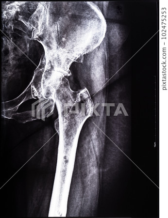 negative x-ray of junction of tibia and pelvis negative x-ray of junction of tibia and pelvis 102475253