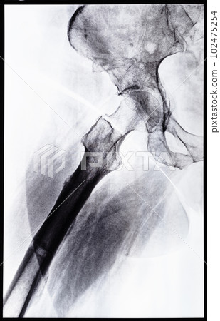 x-ray side view of junction of tibia and pelvis x-ray side view of junction of tibia and pelvis 102475254