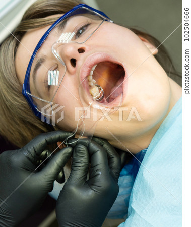 Installation metal clip. Tooth restoration process Installation metal clip. Tooth restoration process 102504666