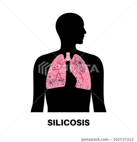 Silicosis dust in lung Silicosis dust in lung 102537222