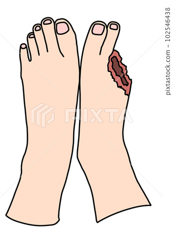 The wound where the toe was necrotic and lost 102546438