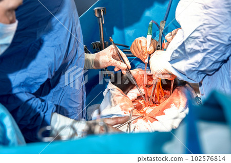 Close-up of the hands of surgeons during an operation on the open abdomen of a patient, sterile medical instruments, teamwork Close-up of the hands of surgeons during an operation on the open abdomen of a patient, sterile medical instruments, teamwork 102576814
