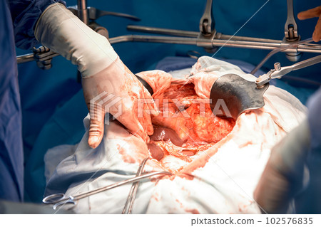 Close-up of the hands of surgeons during an operation on the open abdomen of a patient, sterile medical instruments, teamwork Close-up of the hands of surgeons during an operation on the open abdomen of a patient, sterile medical instruments, teamwork 102576835