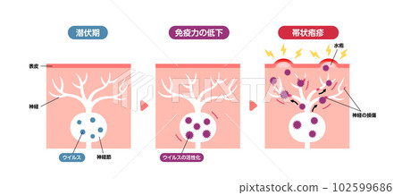 Mechanism of occurrence of herpes zoster / Cross-sectional view of skin Illustrative illustration Mechanism of occurrence of herpes zoster / Cross-sectional view of skin Illustrative illustration 102599686