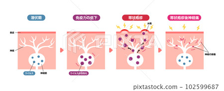 Mechanism of occurrence of shingles / cross-sectional view of skin Illustrated illustration (postherpetic neuralgia) 102599687