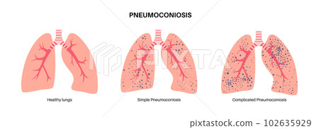 Pneumoconiosis lung disease Pneumoconiosis lung disease 102635929