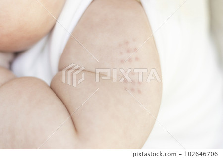 Injection trace of BCG vaccine 5 days after injection 102646706