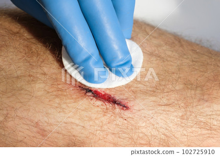 The Wound on a Leg of Young Man. Close Up. Open Red Wound, flows blood, Deep Cut, Dehiscence on Skin. Medical Concept. Laceration Closeup of a large erosion, freshly made, exposed capillaries 102725910
